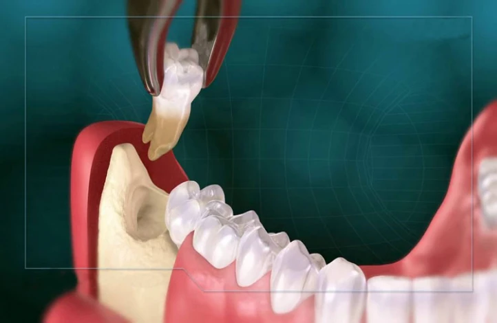 نکاتی که باید قبل از کشیدن دندان عقل بدانید